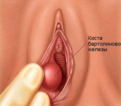 Острый вагинит – причины, симптомы, диагностика и лечение в «Будь Здоров»