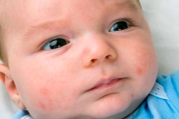 Аллергия лекарственная у детей