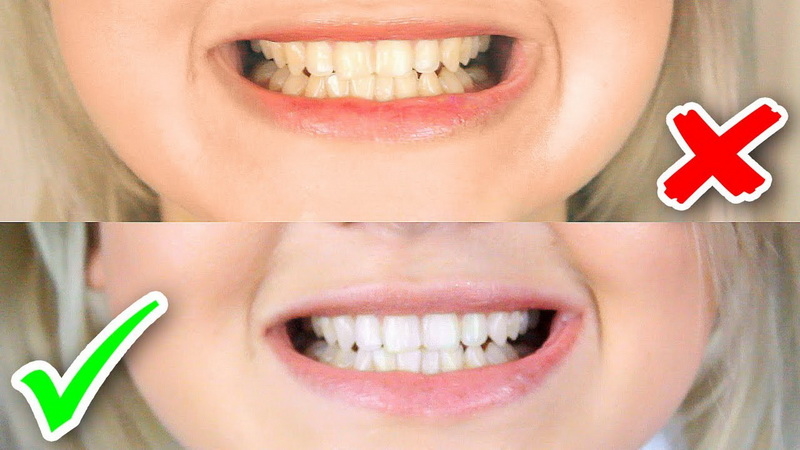 Прием стоматолога + ультразвуковая чистка зубов