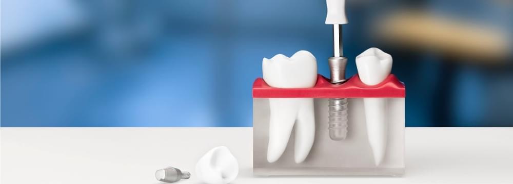 Выгодное предложение на имплантацию зубов на системе Straumann!